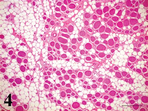 lv lipoma|infiltrating lipoma.